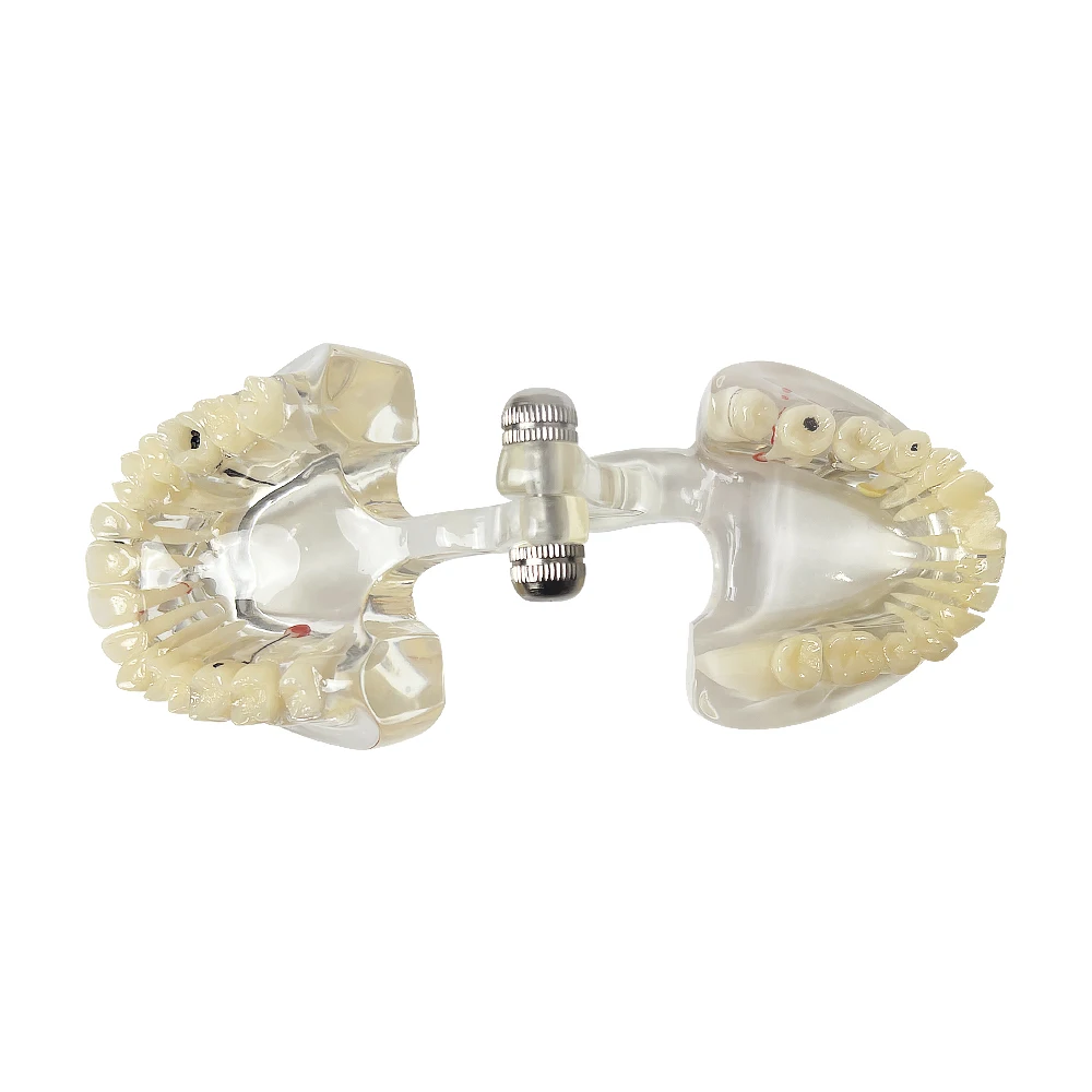 

Dental Pathological Caries Teeth Model With Implant Disease Teeth Dental Demonstration Model For Oral Pathology Research Patient