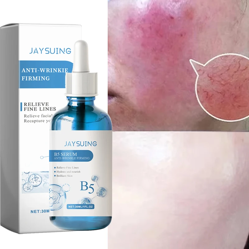 

Facial Redness Spider Vein Removal Serum Sensitive Itchy Skin Soothing Repairing Care Anti Rosacea Treat Lotion Korean Cosmetics