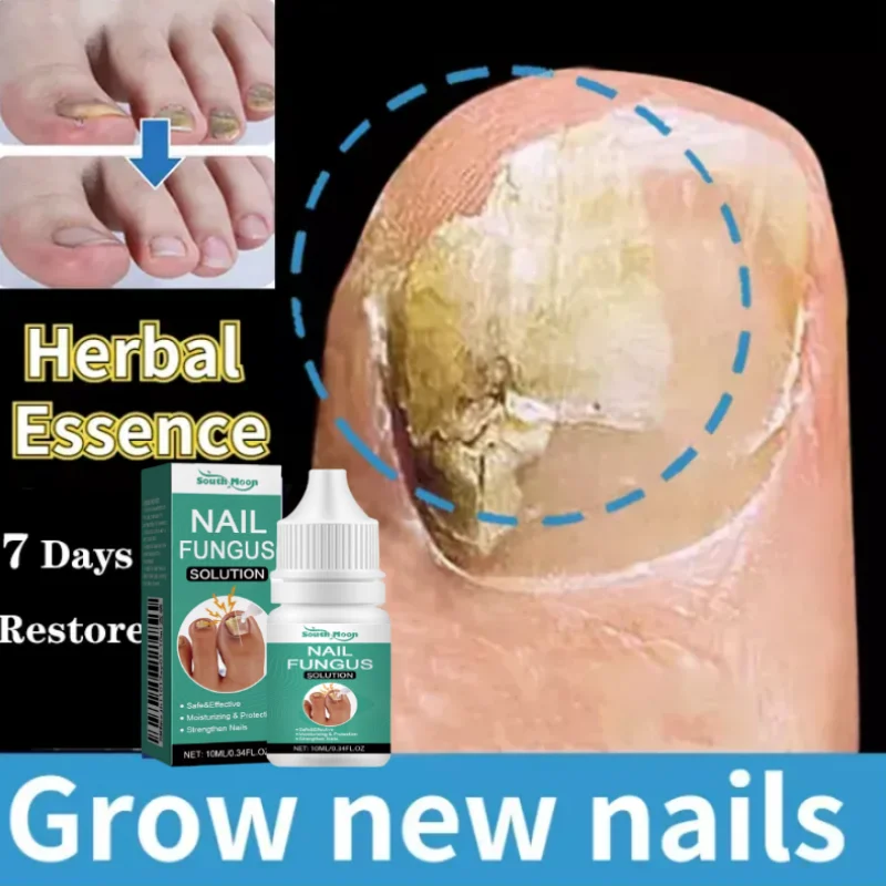 

Nail Fungal Treatment Essence Oil Foot Toe Nail Fungus Removal Serum Repair Toenail Onychomycosi Gel Anti Infection Care