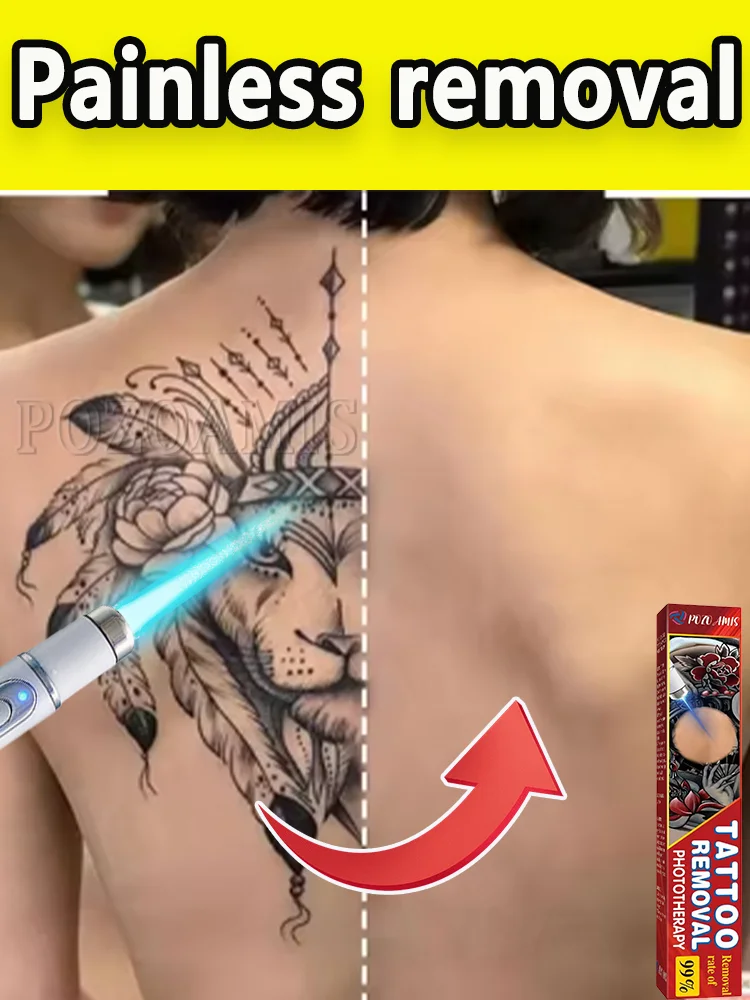 ลบรอยสักสีดำและสีขาวที่มีสีสันหลากหลาย