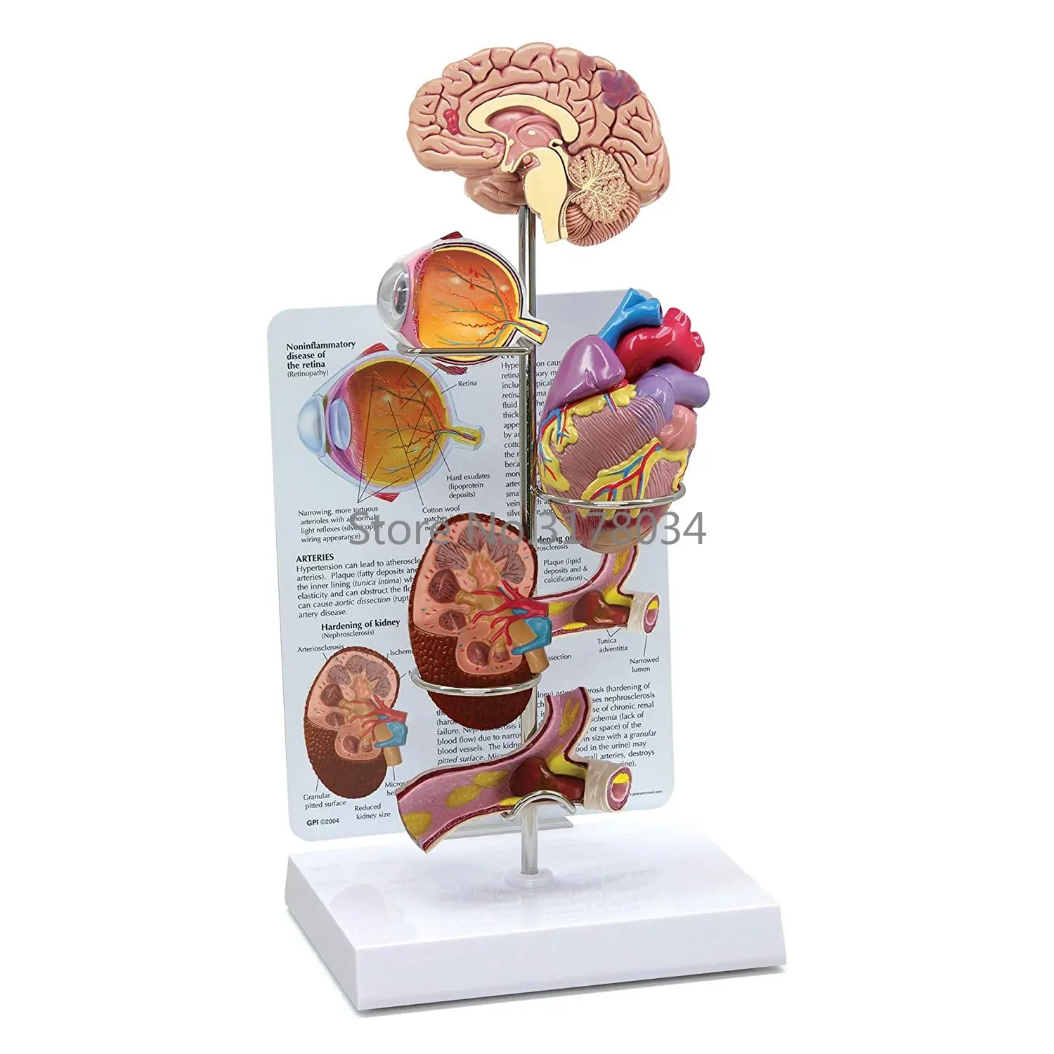 

Hypertension Model Set Human Body Anatomy Replica of The Effects from High Blood Pressure for Doctors Office Educational Tool