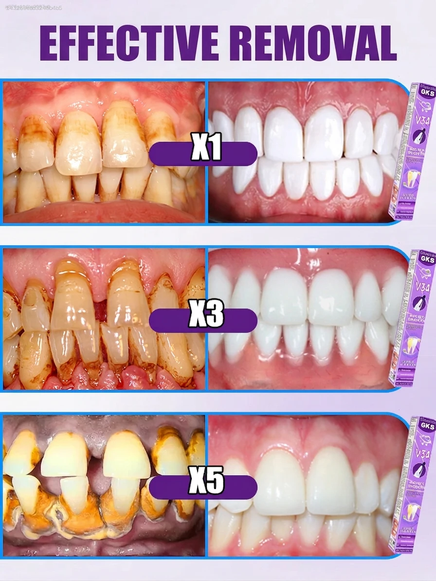 V34 퍼플 치아 미백 펜, 커피 및 담배 얼룩 제거용 - Teeth Whitening Gel Pen 리뷰 및 가격