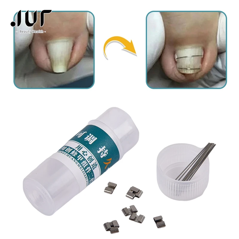 Ingrown Toenail Corrector Tools Pedicure Recover Embed Toe Nail Treatment Professional Ingrown Toenail Straightening Clip Brace