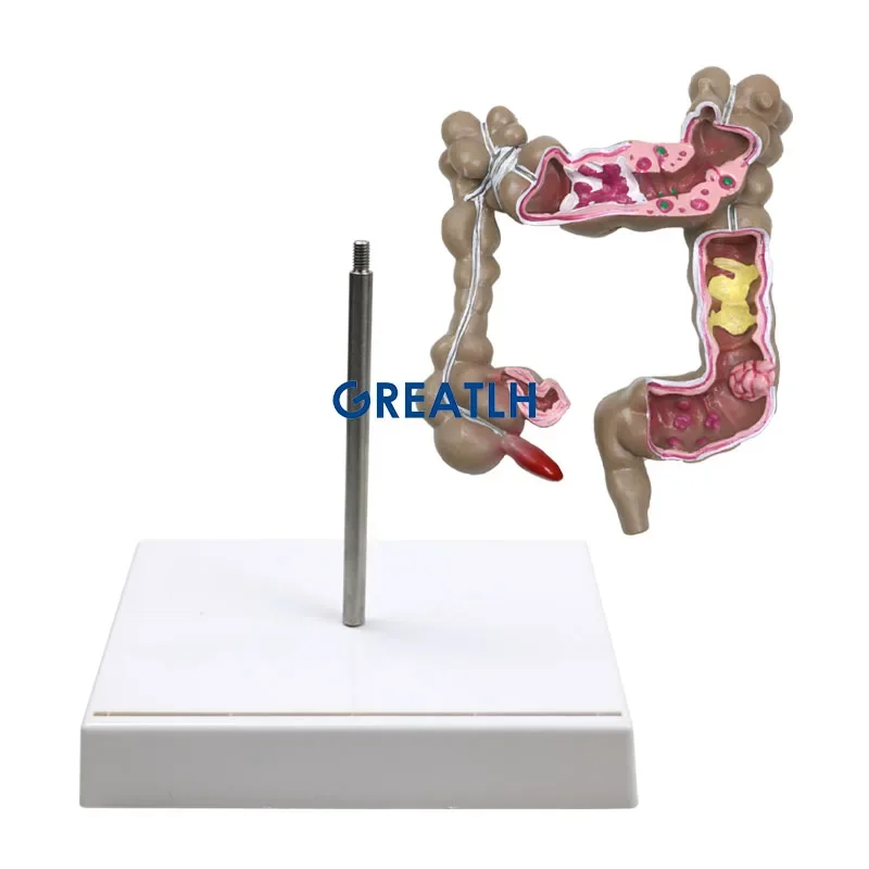 GREATLH Pathological Diseases Model Human Colorectal Lesion Model Teaching Learning Tool