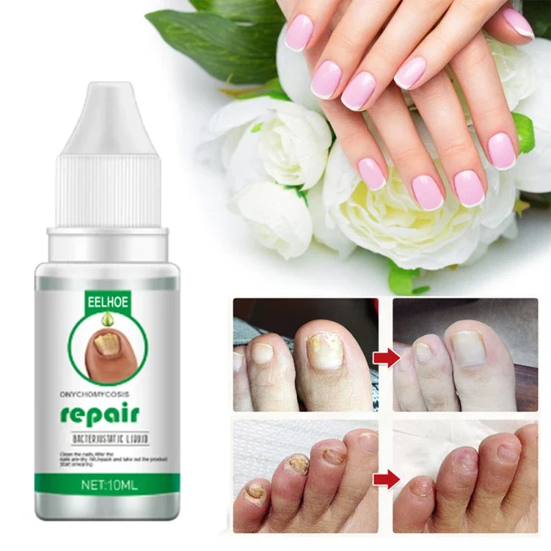 Nail Fungus Treatment Serum Repair Fungus Removal Essence Liquid Onychomycosis Foot Care Gel Anti Infection Thicken Soft Nails