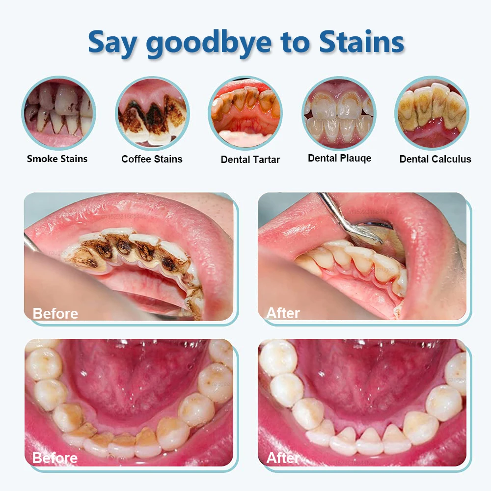 เครื่องขูดหินปูนอัลตราโซนิก กำจัดคราบหินปูน คราบพลัค และคราบหินปูนในช่องปาก เครื่องทำความสะอาดฟันด้วยคลื่นอัลตราซาวด์