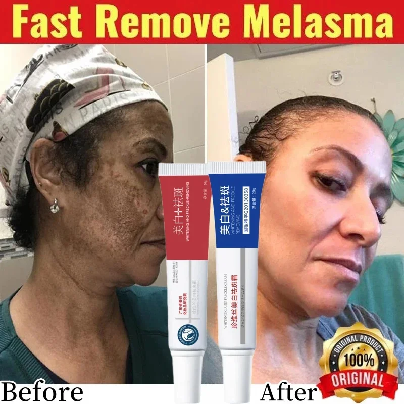 

Freckle Whiten Cream Effective Removing Spot Eliminate Brown Stain Melasma Melanin Blemishes Lighten Moisturiser Face Skin Care