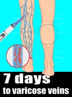 Las herramientas para el cuidado de las piernas eliminan las venas varicosas de las piernas de araña Herramienta de luz azul para venas, más descuentos en juegos