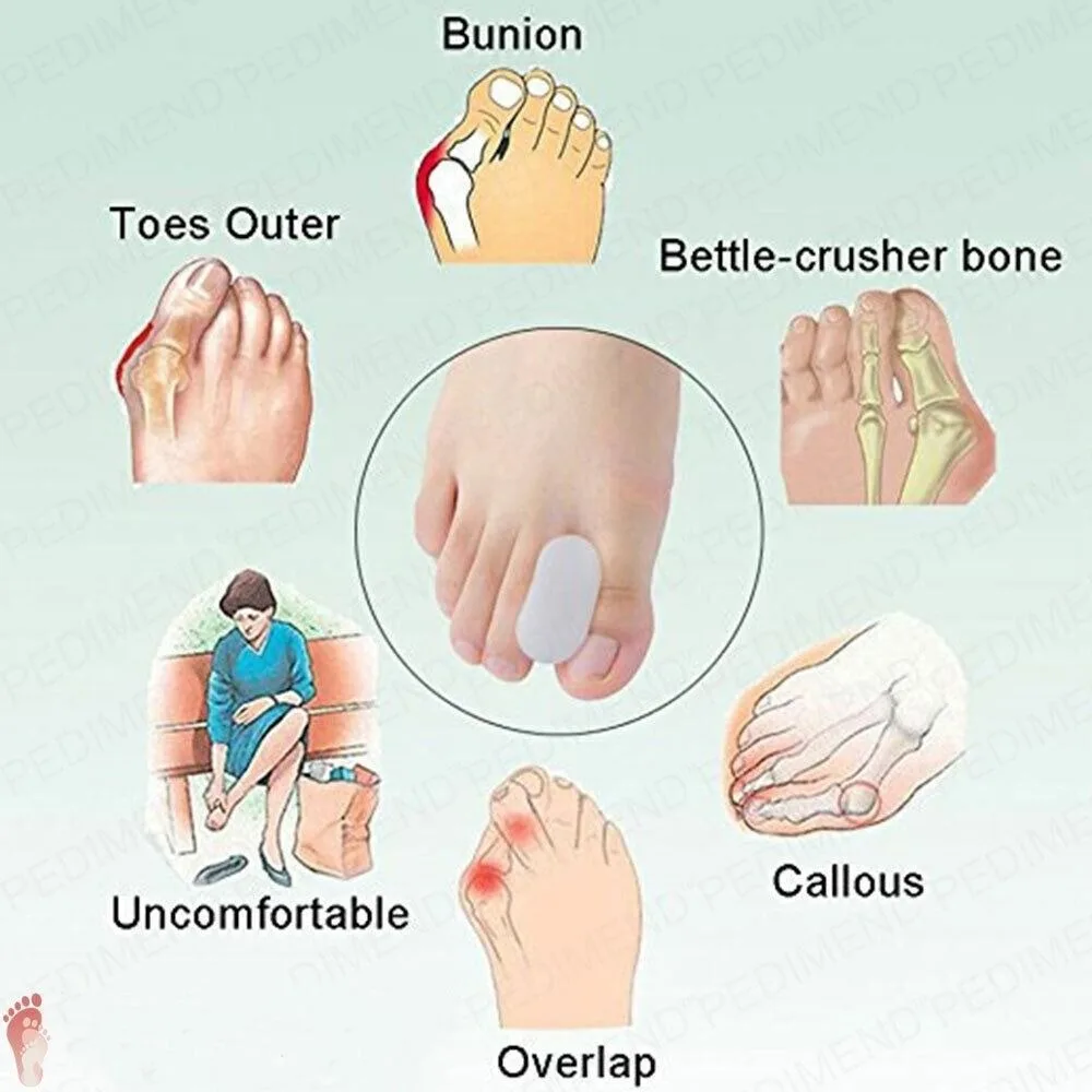 ตัวแยกนิ้วเท้าแบบเจลทำจากซิลิโคนสำหรับชายและหญิงเพื่อ Relief อาการปวดที่นิ้วโป้งแก้ไขนิ้วเท้าที่คั่นนิ้วเท้าที่ทับซ้อนกันของผู้หญิง