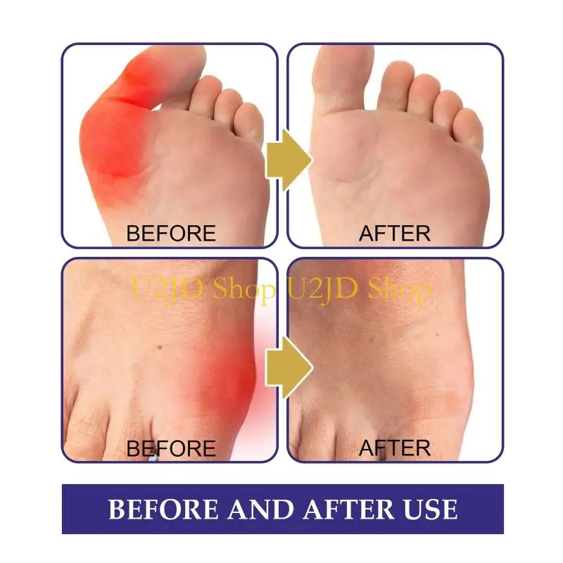 U2JD Daily Use Plant Base Bunions Corrector Antibunion Patches For Foot Relaxation