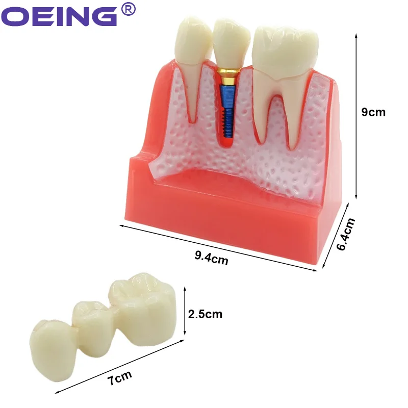 OEING 1Pc Dental 4 Times Teeth Model Implant Analysis Crown Bridge Demonstration Removable Model Lab Oral Research Tools