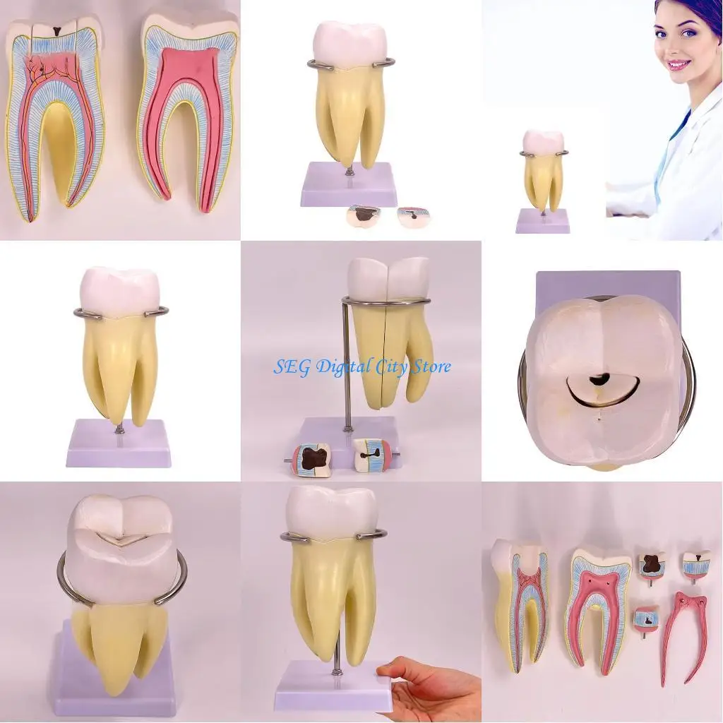 U75B Dental Anatomy Model Molar Tooth Anatomy Model with Detachable Parts Human Tooth Model for Dental Diseases Study
