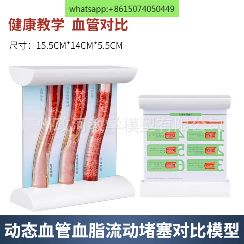 

Dynamic Hyperlipidemic Vascular Blockage State Pathological Vascular Comparison Model Consistency Comparison Teaching