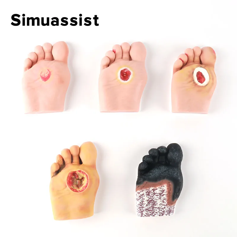 5 Stages Diabetic Foot Model Diabetes Mellitus Foot Disease Classification Educational Demonstration Teaching Model