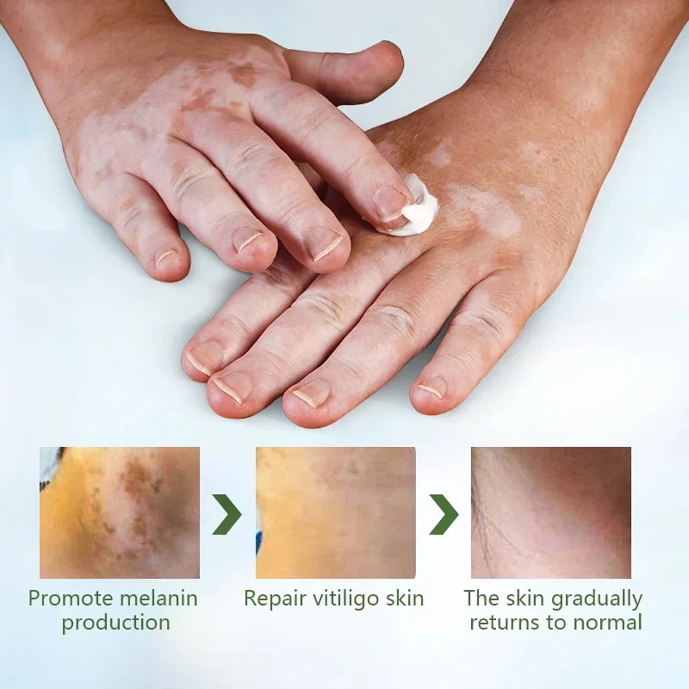 Vitiligo Repair Get Rid Of Ringworm White Spots Get Rid Of Skin Vitiligo Eliminate Vitiligo Better Body Skin