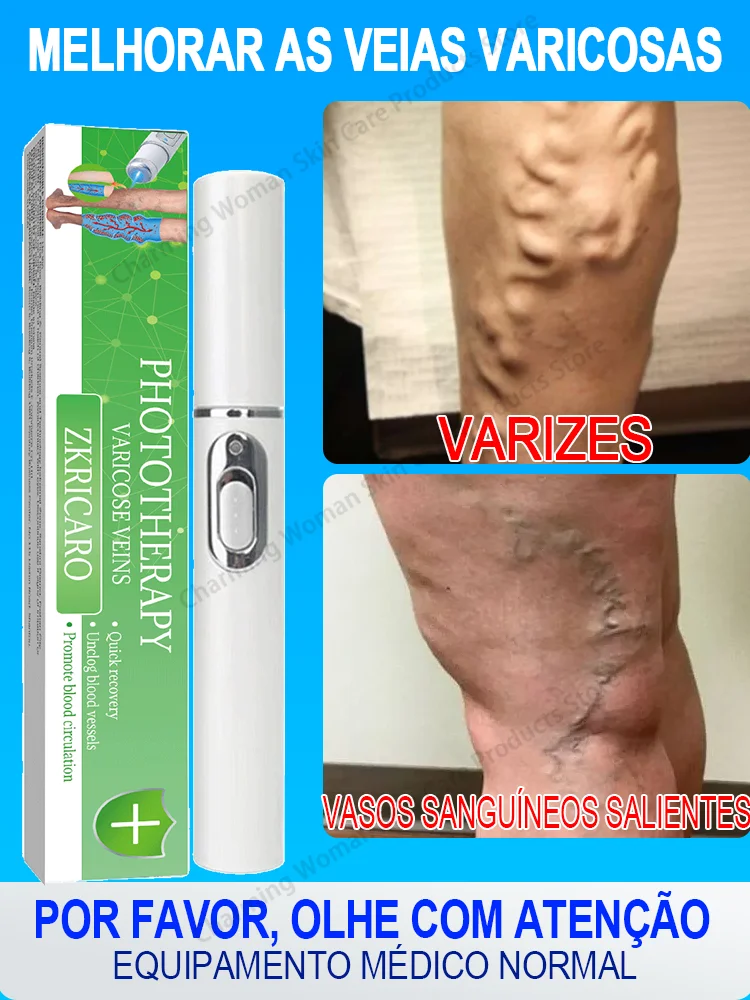 Laser Equipment for Varicose Veins, Clear varicose veins and Relieve Legs