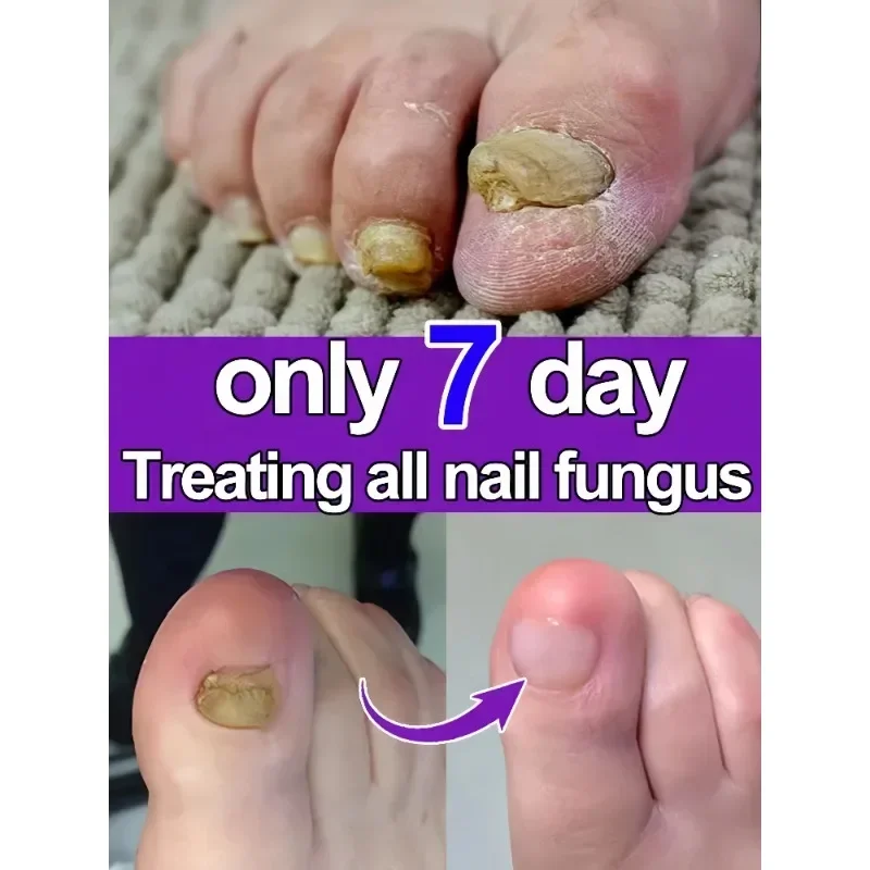 Ätherisches Öl zur Nagelspilzbehandlung, repariert Onychomykose in 7-Tage