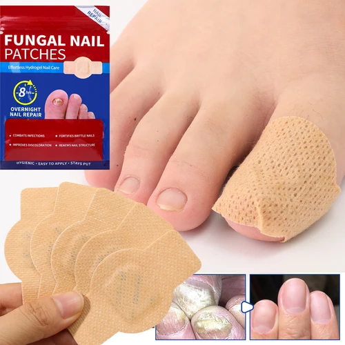 Imagen 2 del producto Parche para hongos en las uñas, parche impermeable para reparación de uñas, pegatina de corrección encarnada, parche para el cuidado de los pies, herramientas para el cuidado de los pies, 21/105 Uds.
