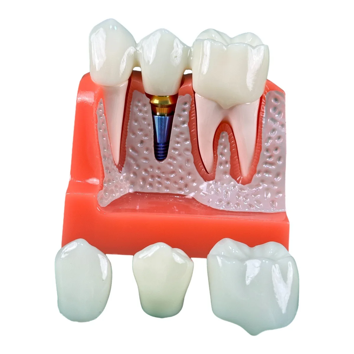 6x Dentistry Students Practice Teeth Models Planting Nail Display Model Medical Teaching