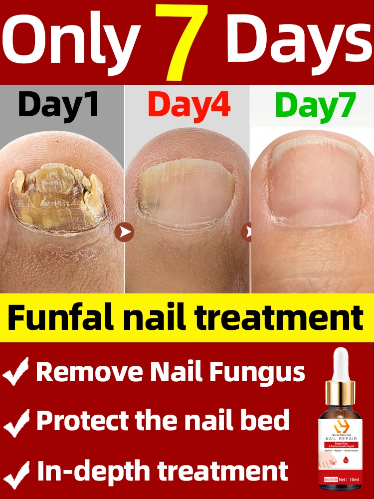 Elim-inate Fung-al Nai-ls Permanently