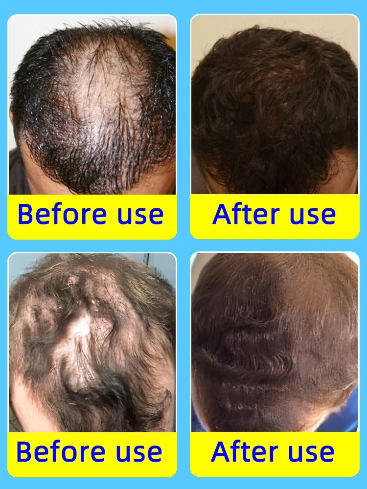 De haargroeiproducten kunnen de hoofdhuid penetreren, wees gerapporteert de haargroei en herstelt het verloren haar