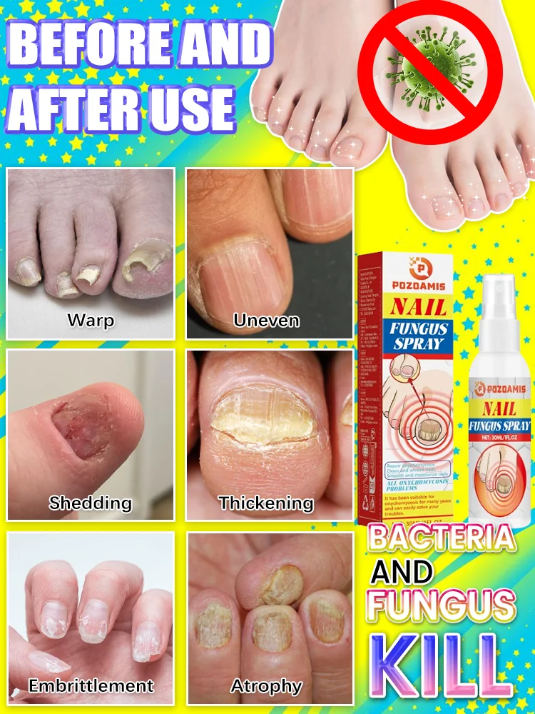 Spray per onicomicosi, facile da usare ovunque e ovunque, continua l'utilizzo e l' onicomicosi non