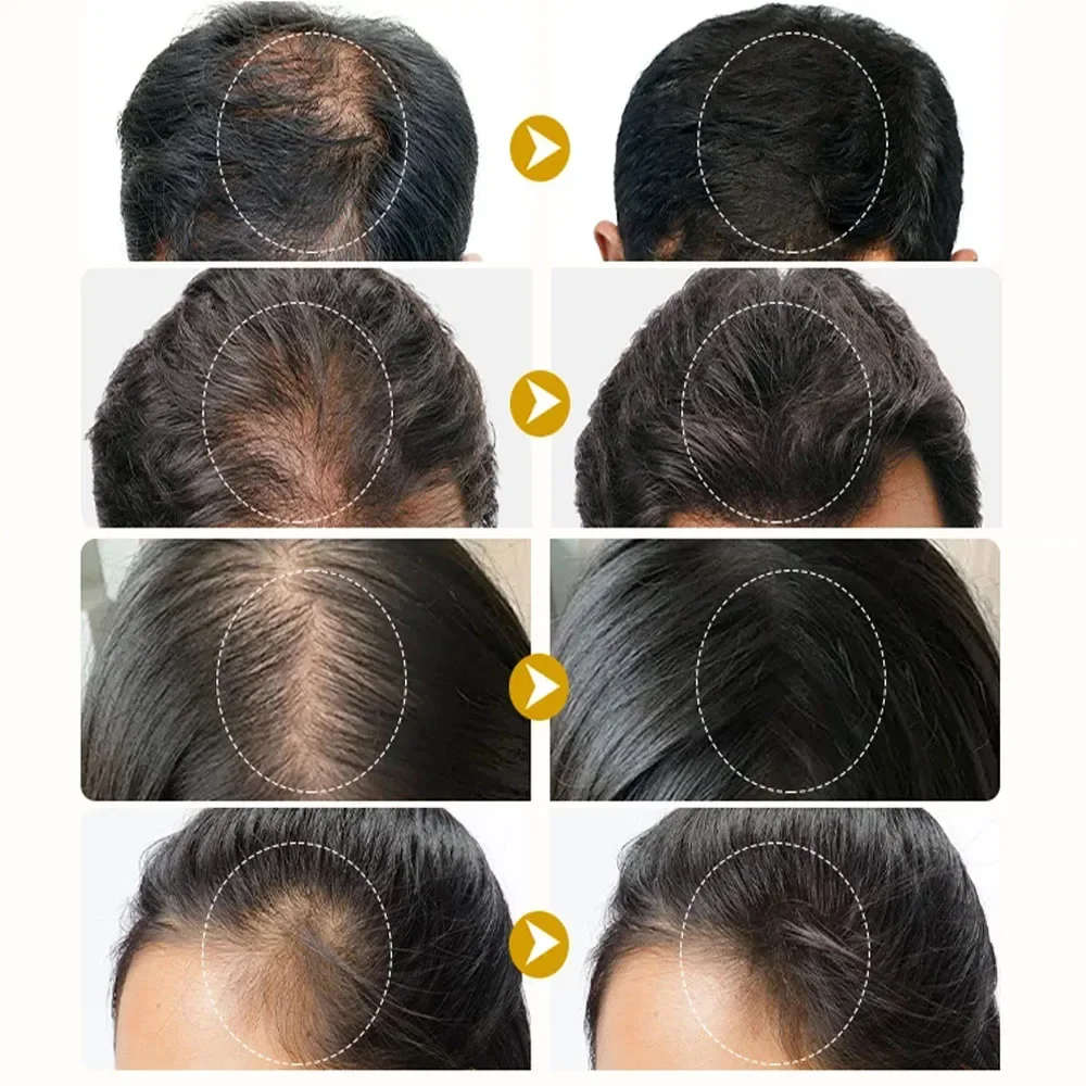 Semprotan Pertumbuhan Rambut Jahe Cepat, Menumbuhkan Akar, Anti Rambut Rontok, Serum Penumbuh Rambut, Perbaikan Kulit Kepala Rusak, Produk Perawatan Menutrisi untuk Wanita dan Pria