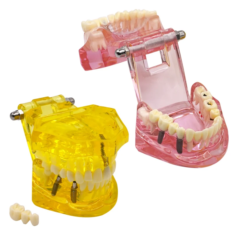 1pc Removable dental models, yellow and pink dental teaching models, resin dental models, oral dental models