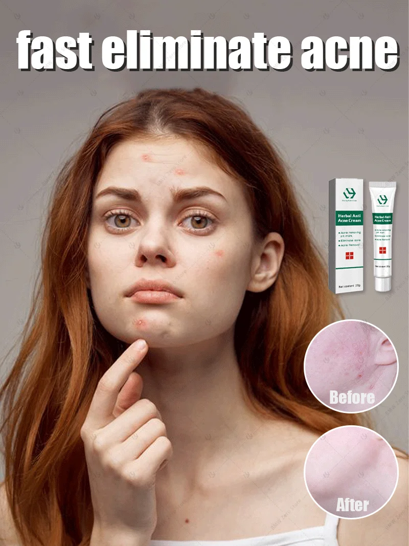 

Effective Acne Removal Cream Anti-Acne Repair Redness Pimple Spots Gel Deep Cleaning Pore Oil Control Moisturizing Skin Care