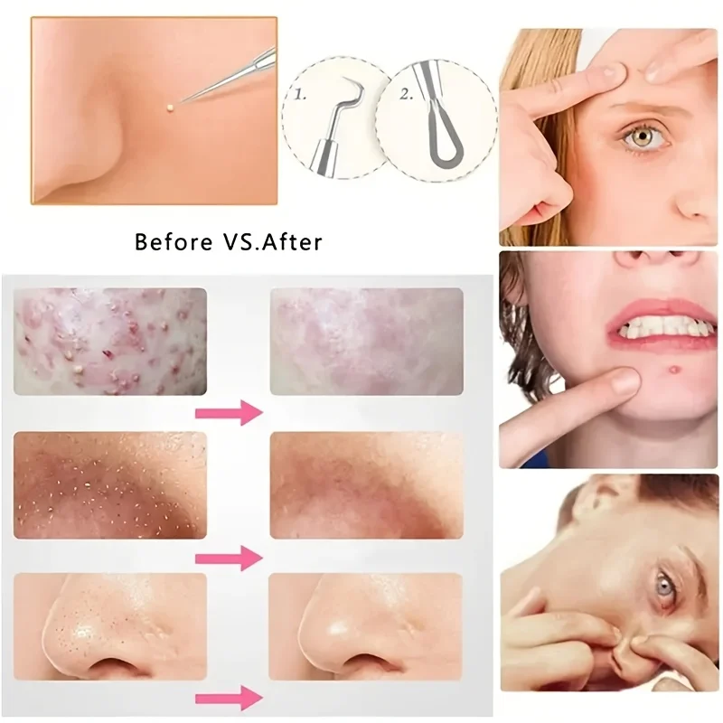 Estrattore di comedoni per punti neri da 5 pezzi, kit di pinzette per punti neri curvi, kit di strumenti professionali per imperfezioni di brufoli in acciaio inossidabile