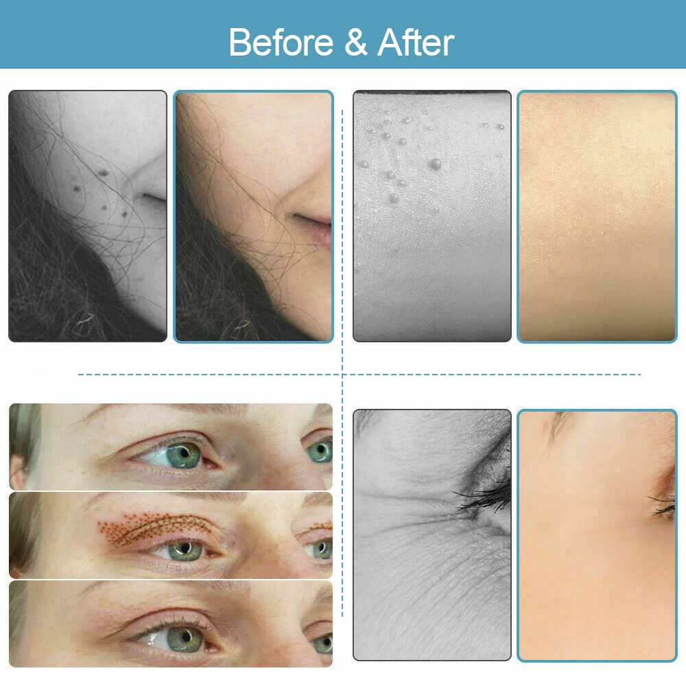 FibroCyclPlasma-Stylo de levage des barrage pour le raffermissement de la peau, laser médical, point noir, tatouage, tache de rousseur, dissolvant de taches sombres, machine