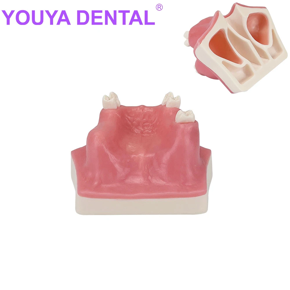 

Dental Implant Teaching Model Upper Jaw Sinus Lift Implants Model for Dentist Student Practice Studying Medical Practice Teeth M