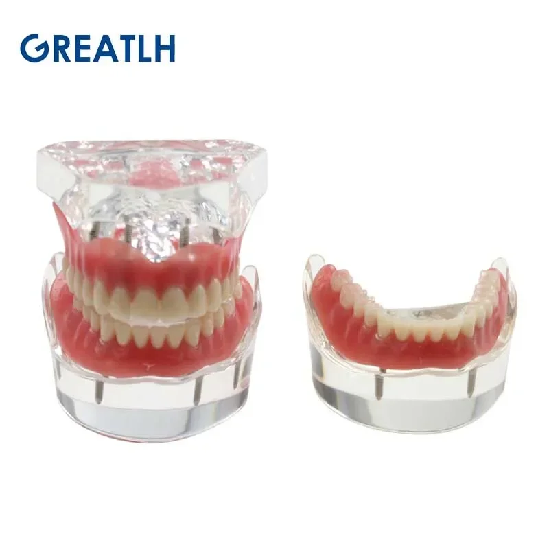 Dental Teeth Model with Implant Overdenture Inferior Demo Mandibular Model Dentist Student Learning Model