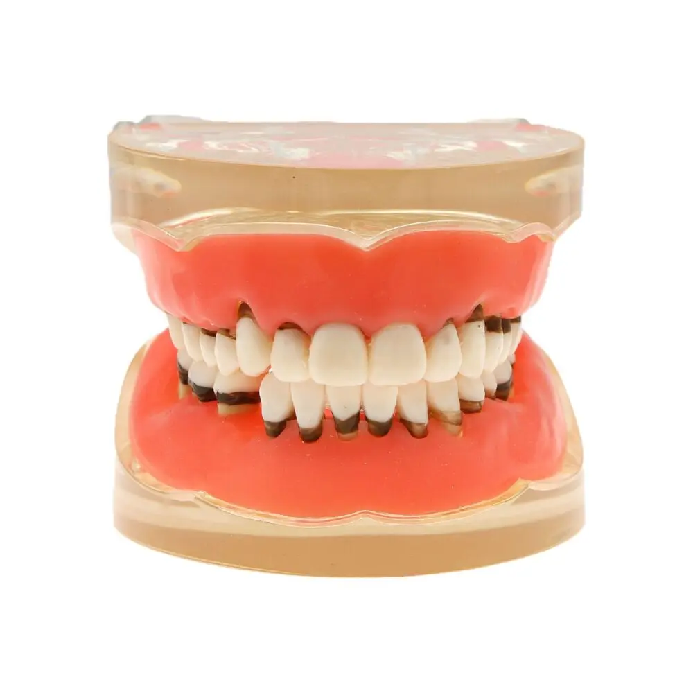 

Dental Teeth Model Adult Periodontal disease Pathological Teaching Studying Demo 3 Removable Teeth M4017