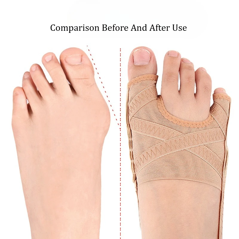1pair Double Toe Toot Protector Bunion Corrector Adjustable Breathable Hallux Valgus Little Toe Varus Separator Foot Care Tools