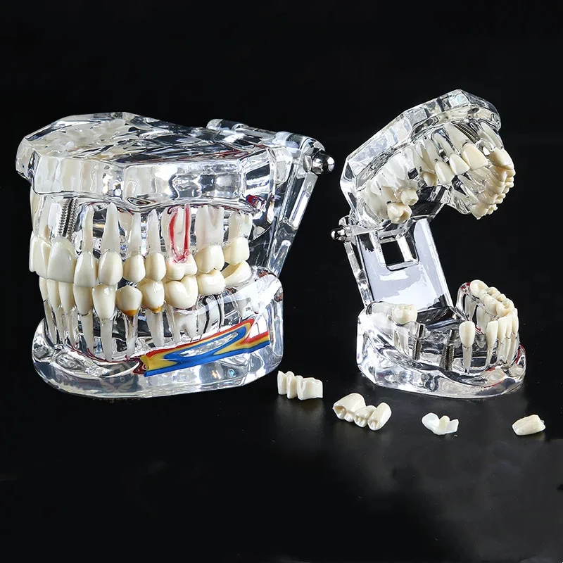 

Модель для реставрации зубов: Патология полости рта, обучение стоматологов, комплексная модель с нервными волокнами, съемная часть