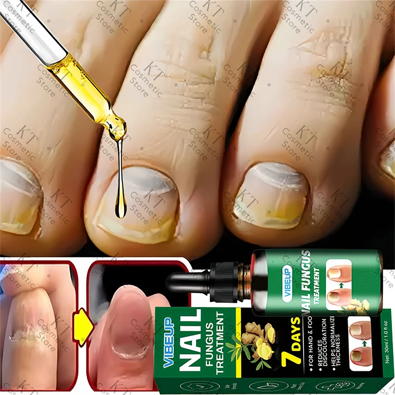 7 Days Nail Fungus Treatment Serum Ginger Anti-Infective Paronychia Onychomycosis Toe Foot Nail Fungal Repair Gel Hand Foot Care
