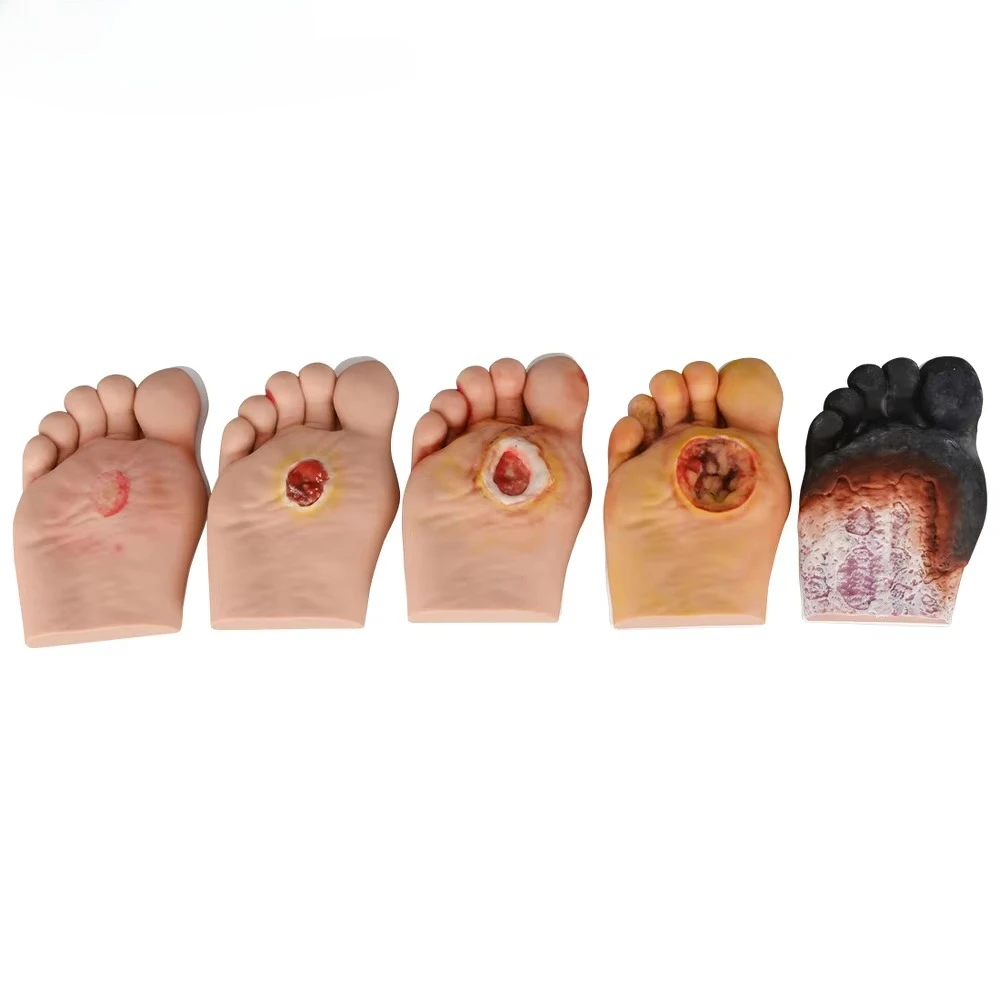 

Scientific Diabetic Foot Model Set, Disease Model Medical Science