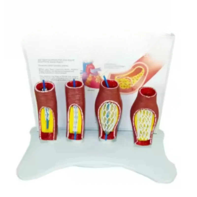 

Coronary Heart Disease Human vascular occlusion stent model human cardiovascular and cerebrovascular occlusion