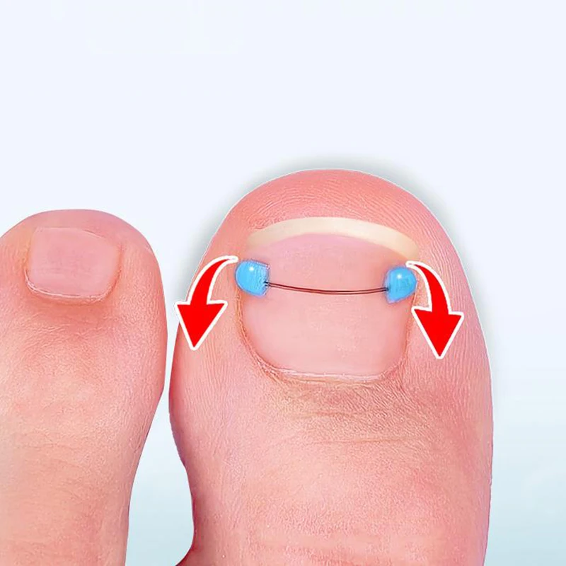 Ingrown Toenail Blue Correction Wire Foot Care Professional Treatment Recover Embed Toe Nail Pedicure Straightening Toe Tools