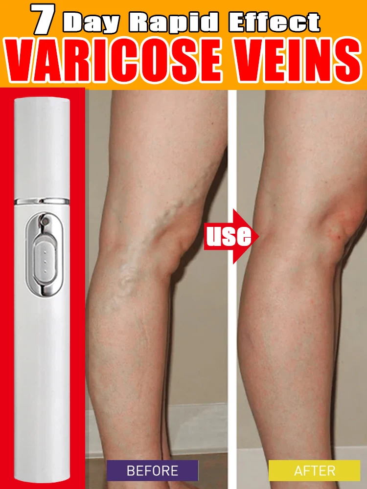 Varicose Vein Treatment Effective Natural Ingredient Varicose Vein Relief Relief from Vasculitis Phlebitis Spider Pain Treatment