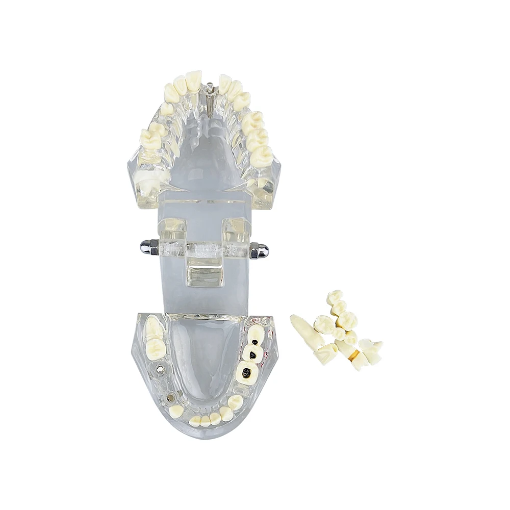 Zdejmowane przezroczyste choroby Model zębów zęby przywrócenie Model dla dentysty Student praktyki szkolenia jamy ustnej medyczne modele