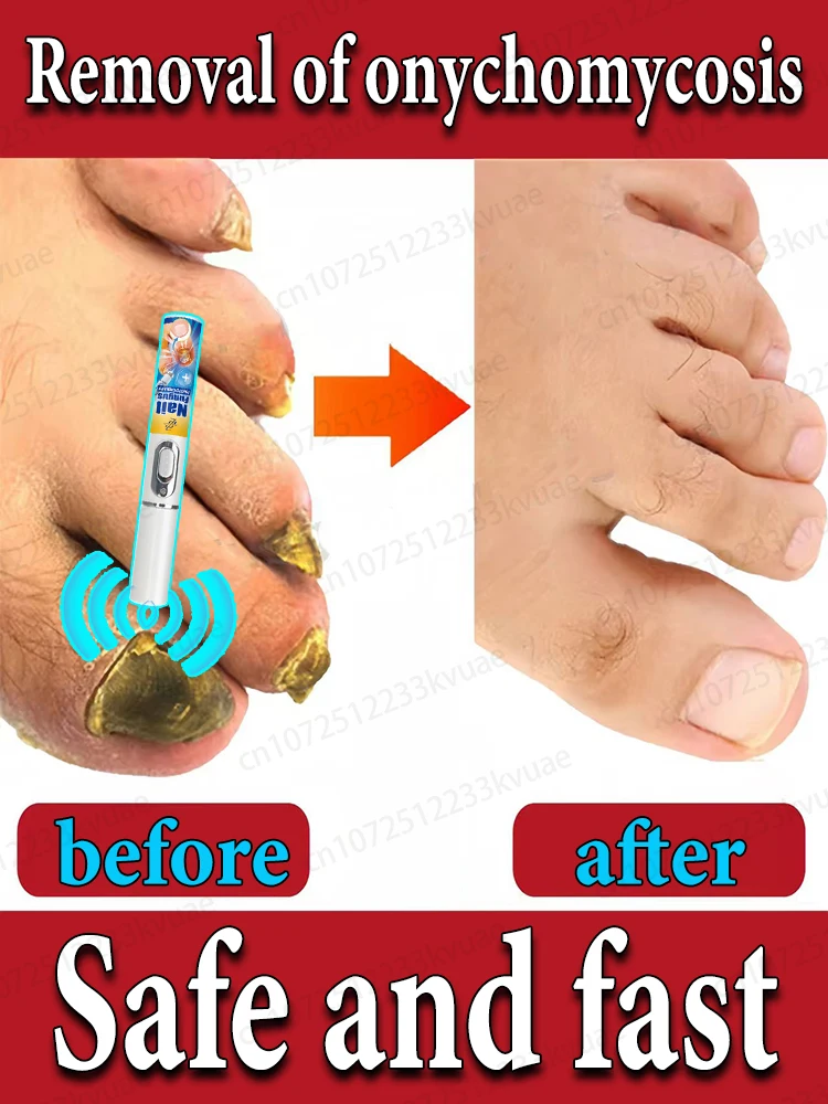 

Repair onychomycosis and restore the original color of nails