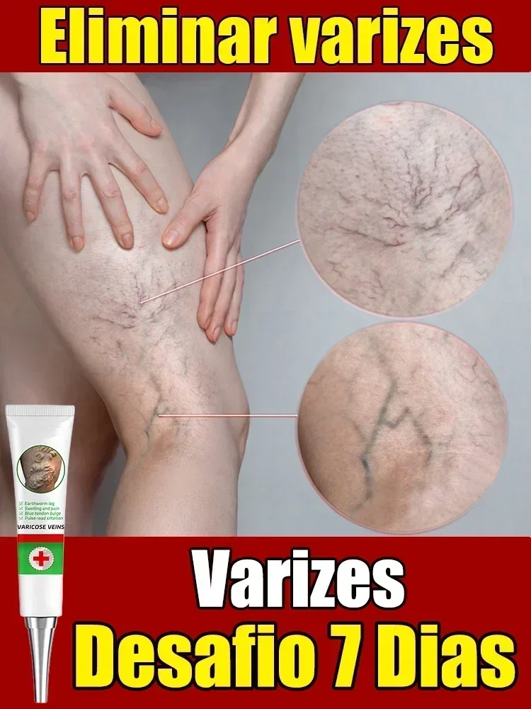 Effective varicose vein soothing cream. Vasculitis, phlebitis, spider leg soothing cream