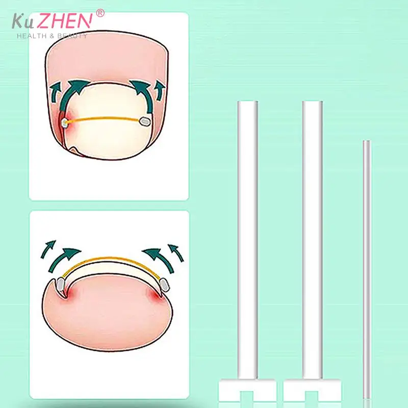 1set Ingrown Toenail Corrector Pedicure Recover Embed Toe Nail Treatment Professional Ingrown Toenail Straightening Clip Brace