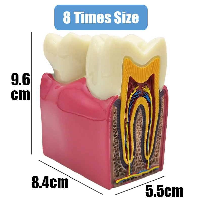 8 Times Dental Caries Model Disease Teeth Dental Model for Dental Demonstration Model Dentist Teaching Dental Lab Oral Research