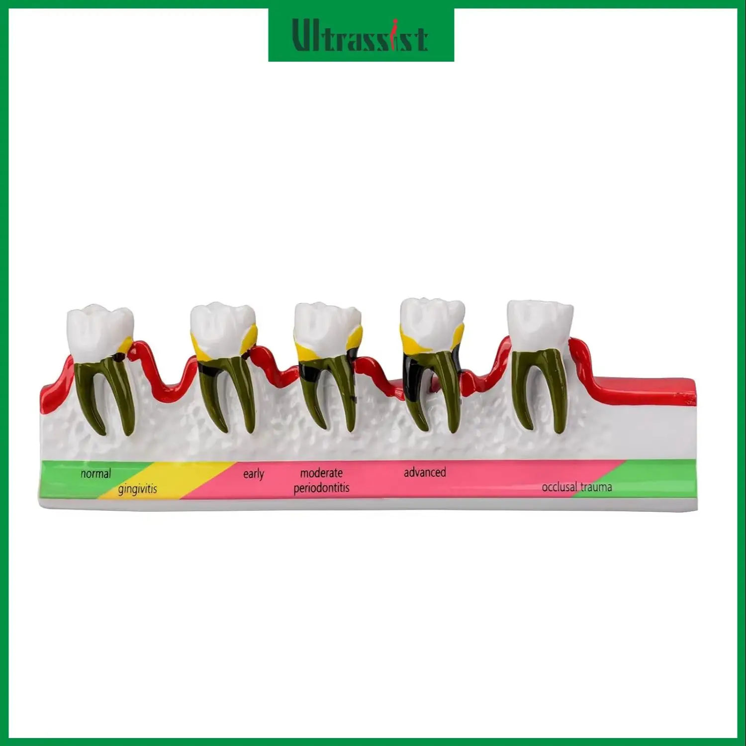 Ultrassist Dental Periodontal Disease Model Dental Teeth Anatomy Study Tool Tooth Model for Doctor-Patient Oral Care Education