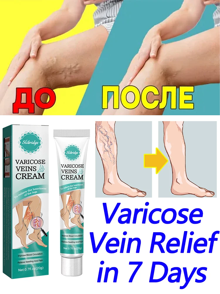 

Effective varicose vein soothing cream. Vasculitis, phlebitis, spider leg soothing cream