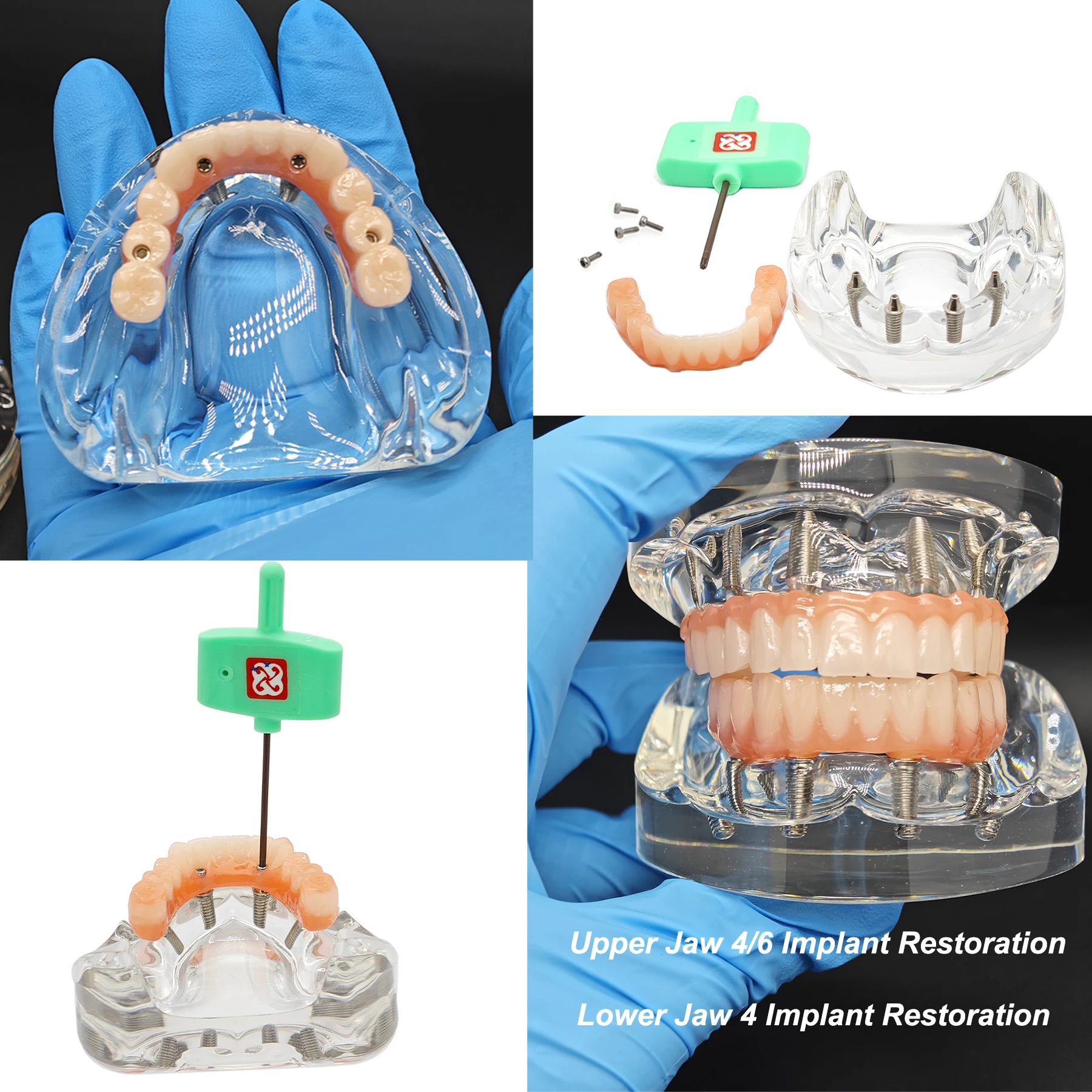 

Dental Implant Teeth Model Transparent Upper/Lower Jaw Type Overdenture Modle With 4/6 Removable Implant Screws Dentist Teachin