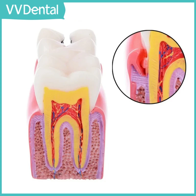 

6 Times Dental Caries Comparsion Models Dental Teaching Model For Dental Study Teaching Dental Anatomy Endodontics Education